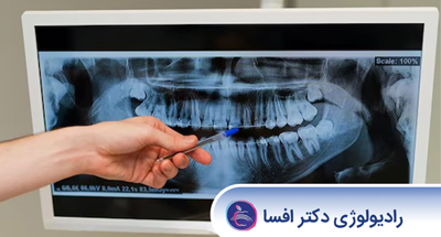 رادیوگرافی داخل دهانی